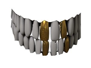 金歯
